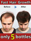 Hair growth essential oil, treatment for hair loss, baldness